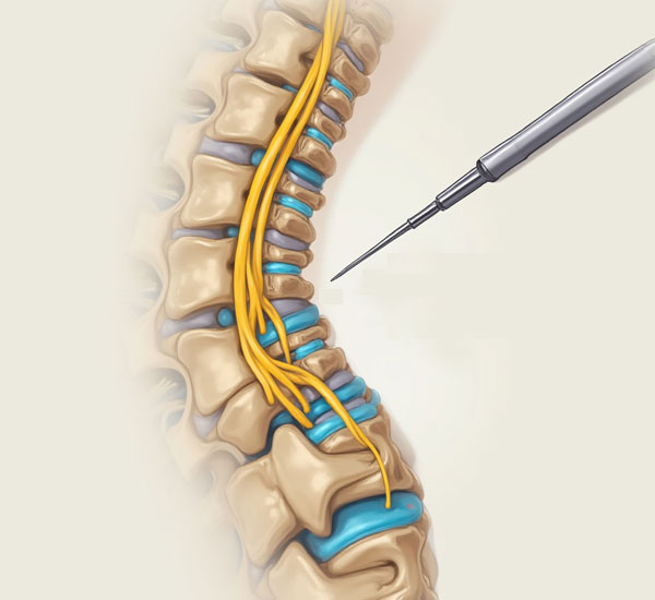 Root Block Treatment in West Delhi, Rajouri Garden