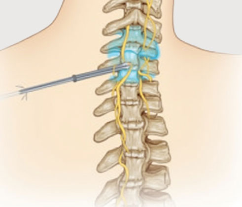 Transformational Root Block Treatment in West Delhi