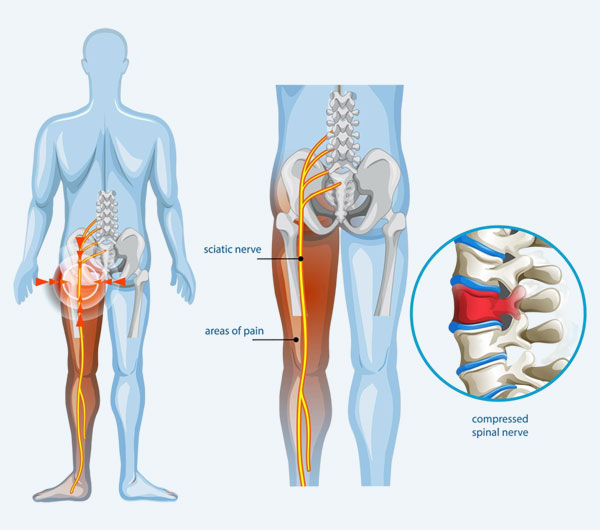 Non-Surgical Sciatica Pain Treatment in West Delhi, Rajouri Garden