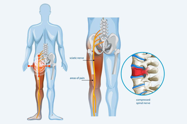 Sciatica Pain Treatment in West Delhi