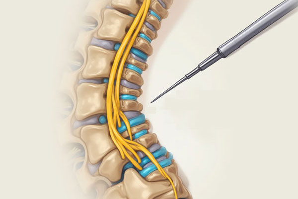 Root Block Treatment in West Delhi